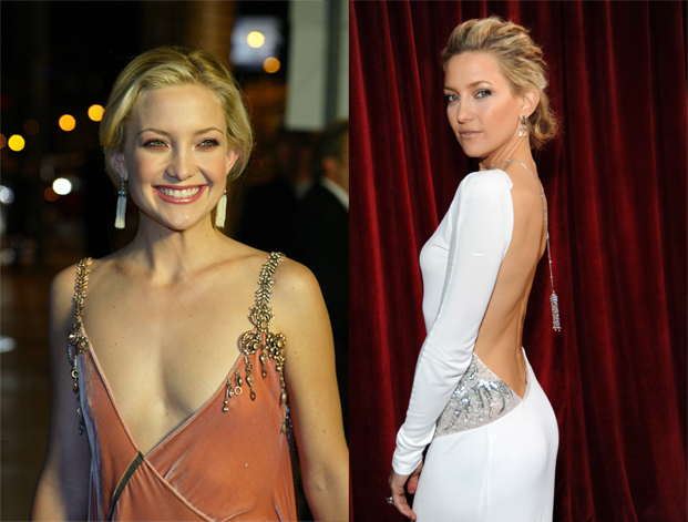 Celebrity Plastic Surgeries Gone Right