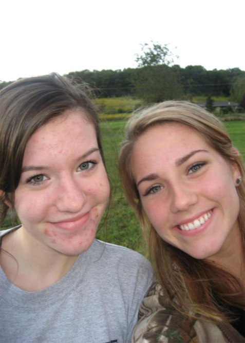 STYLECASTER | Learning to Love My Acne-Prone Skin