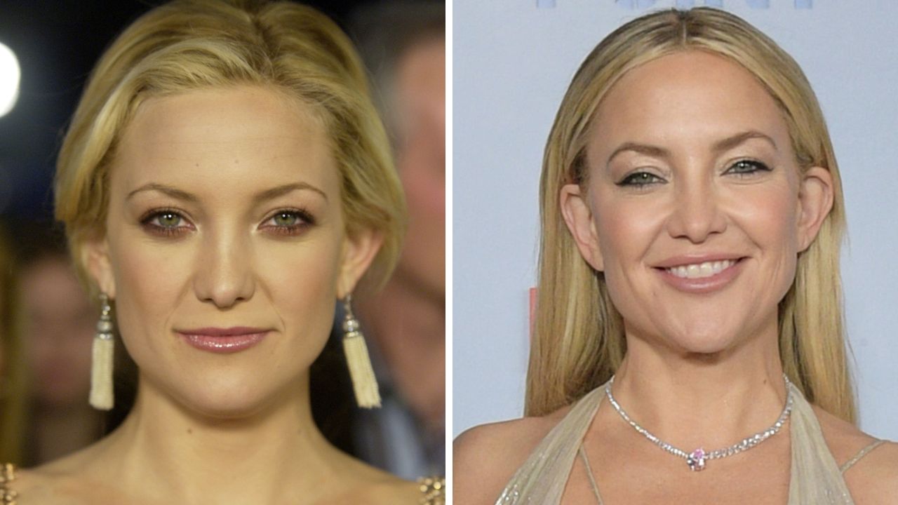 Kate Hudson Surgery